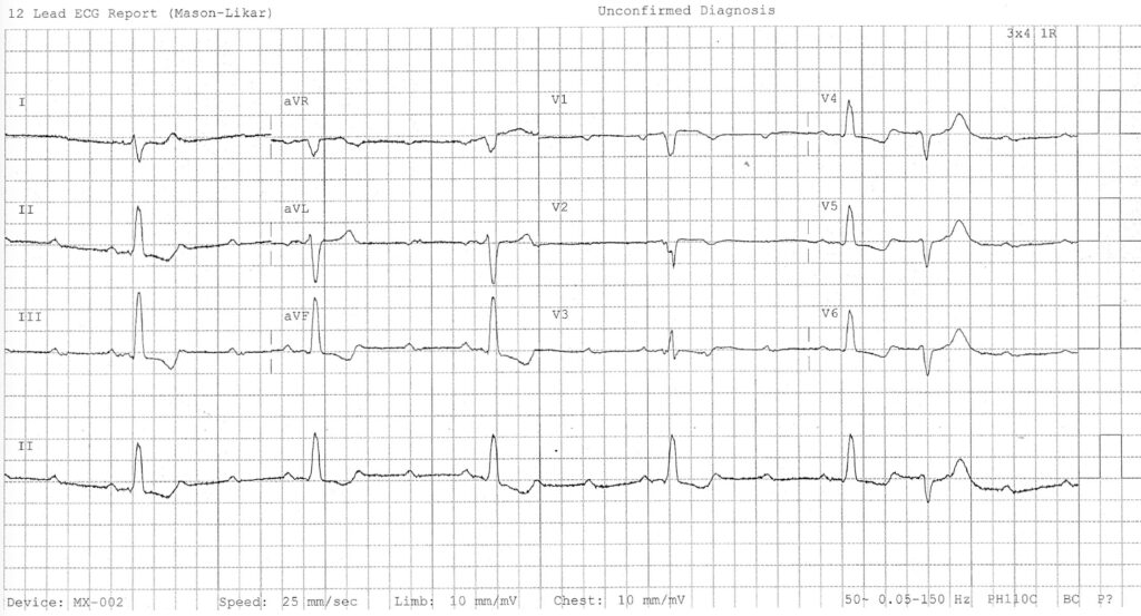 Hay Block ECG
