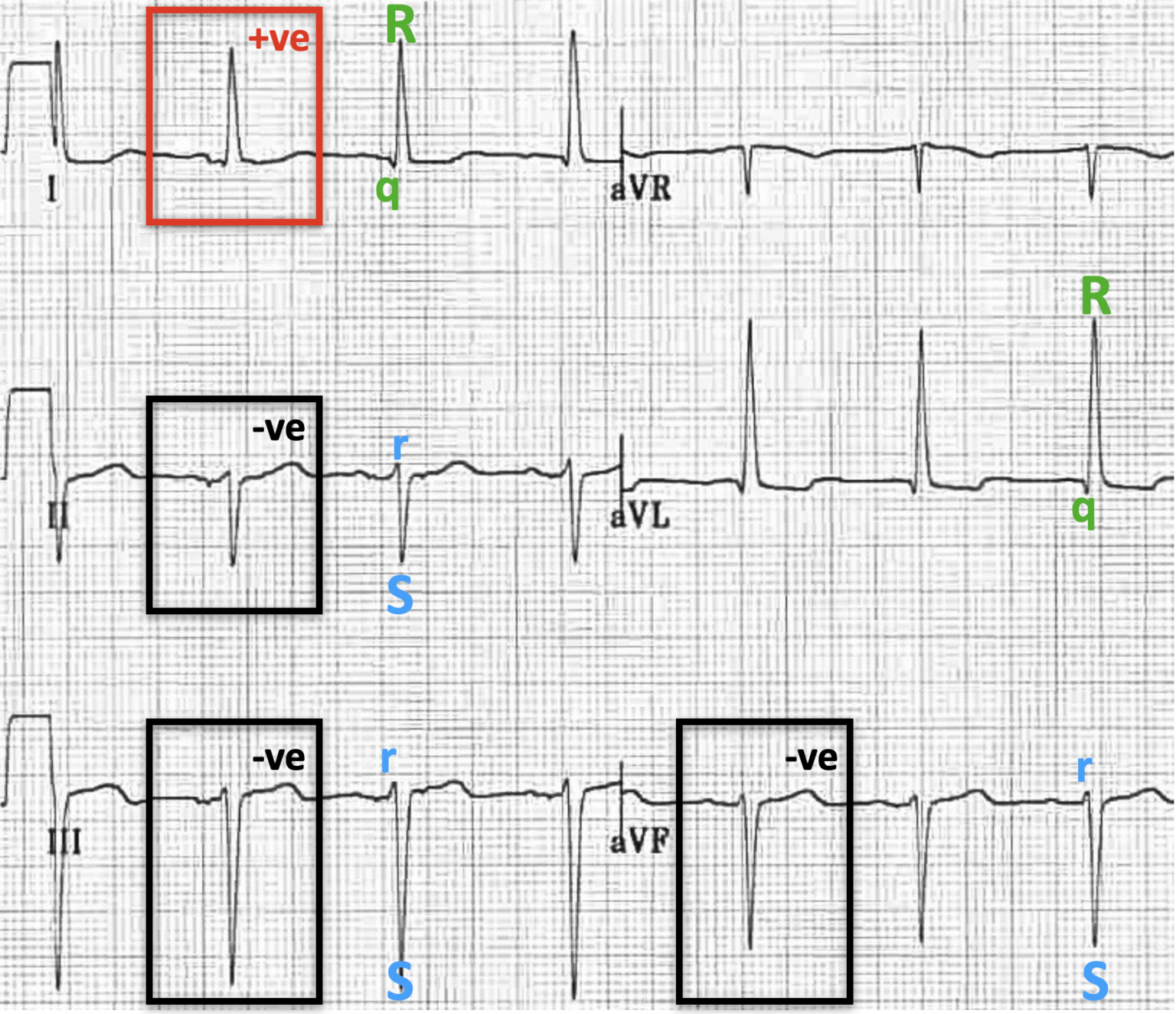 left-anterior-fascicular-block-lafb-litfl-ecg-library-diagnosis