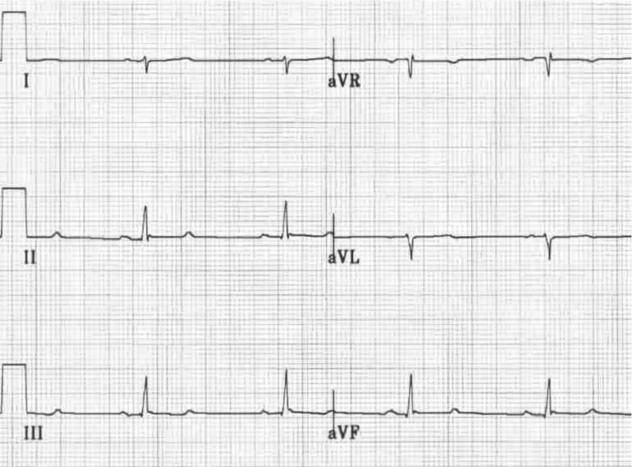 Left Posterior Fascicular Block (LPFB) • LITFL • ECG Library Diagnosis
