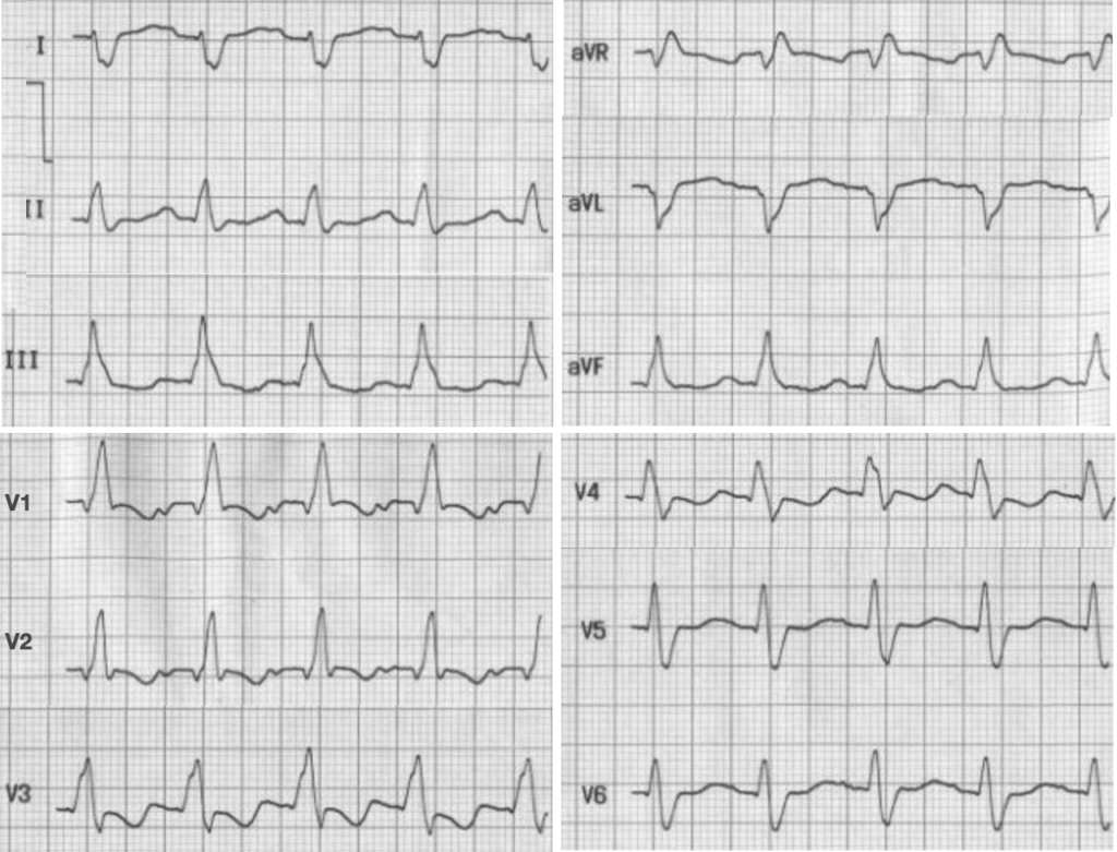 RBBB with LPFB bifascicular block 2