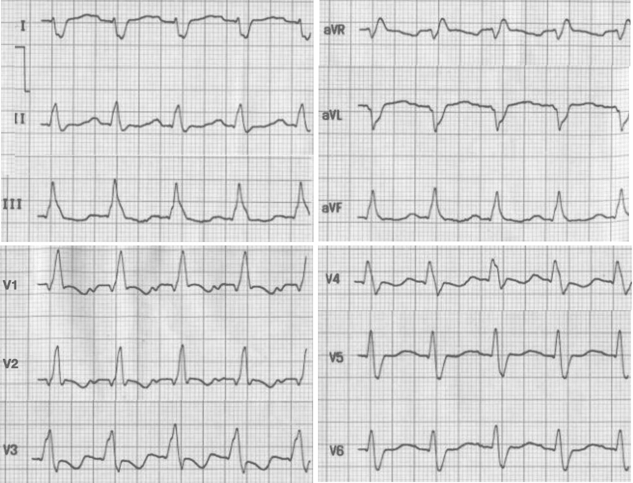 Left Posterior Fascicular Block Lpfb Litfl Ecg Library Diagnosis