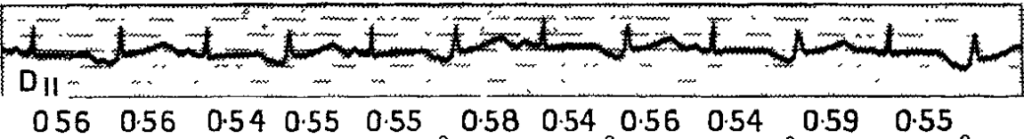 Romano 1963 QT prolongation in 3 month old