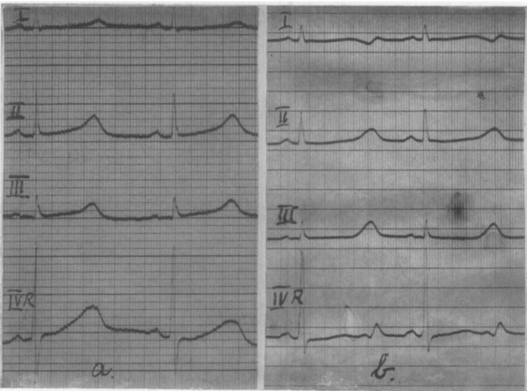 JLNS 1957 case 1 pm