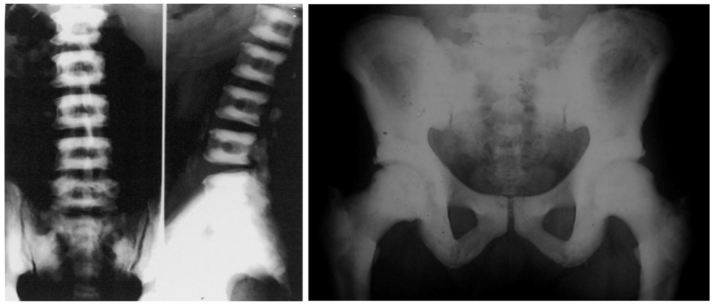 Albers-Schönberg disease ADO II