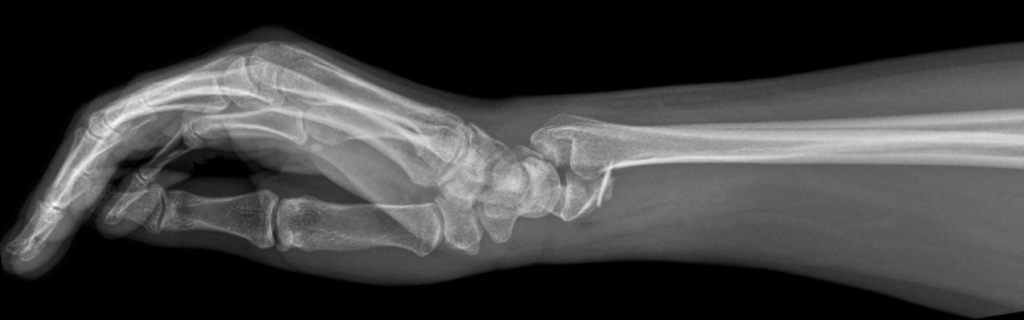 Volar Barton fracture