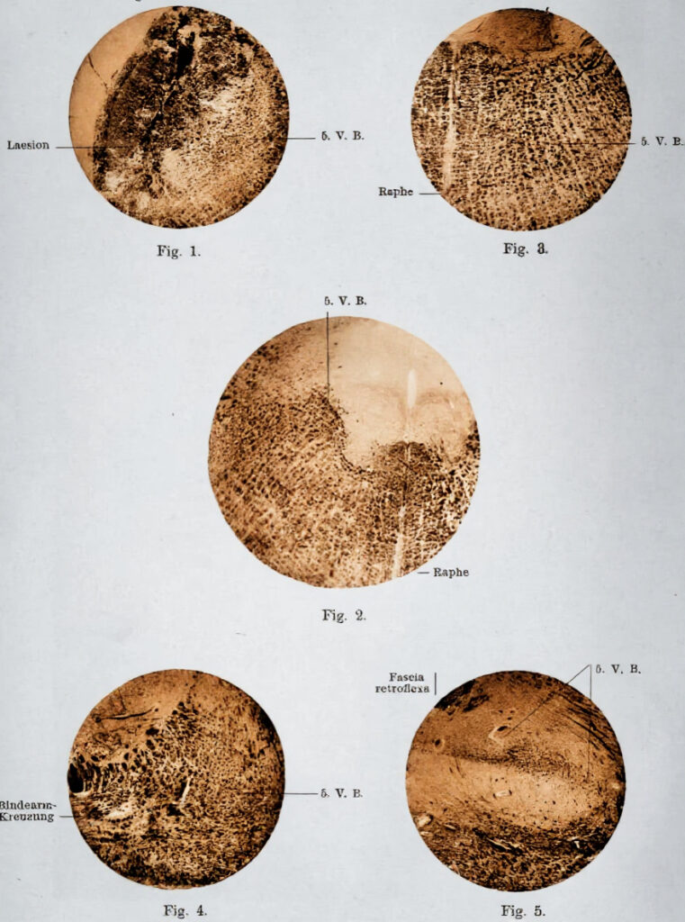 Wallenberg's Tract
