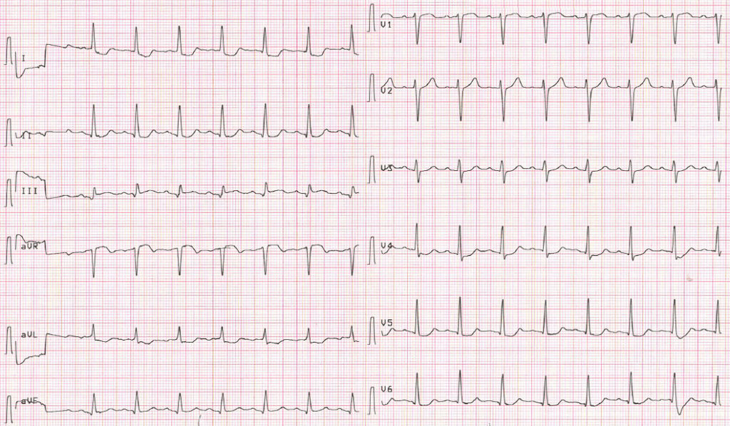 Aslanger pattern of ECG changes in inferior myocardial infarction 2020