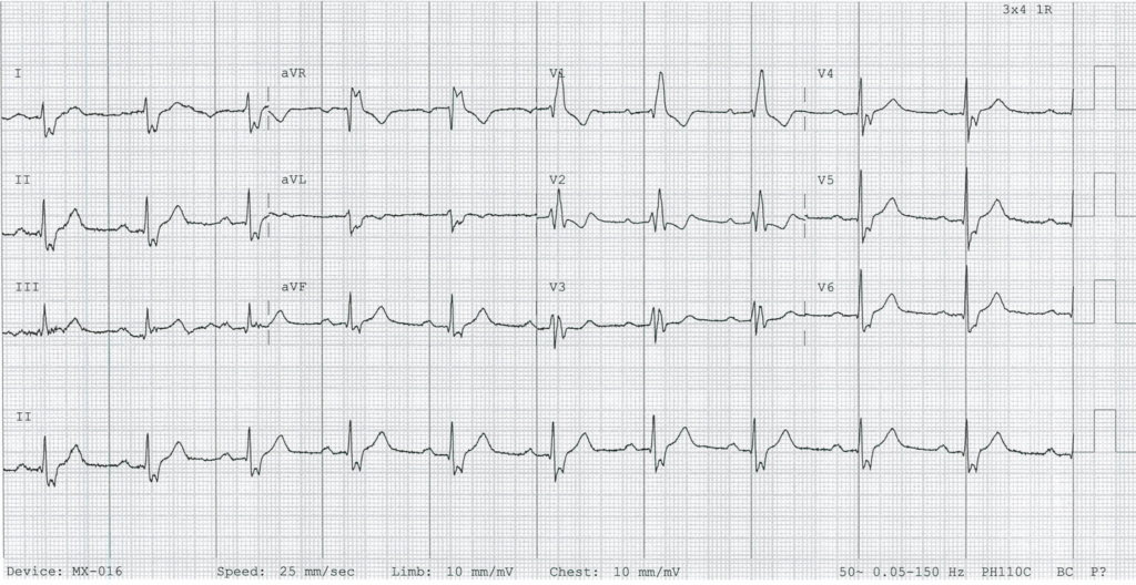 Bifascicular block RBBB LPFB RAD