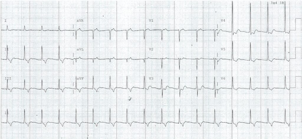 Fast-Slow AVNRT slow palpitations