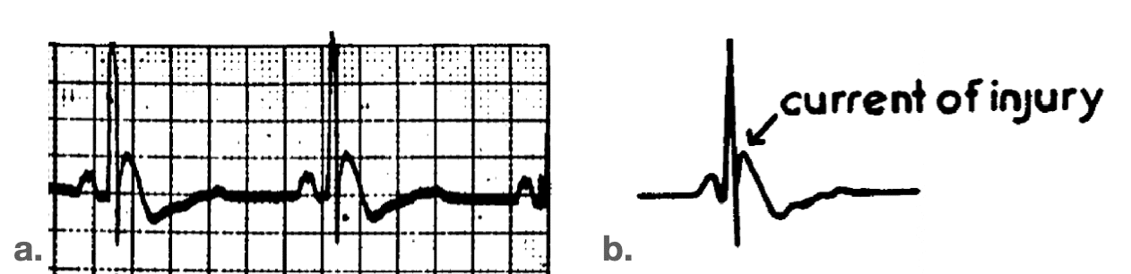 Osborn Wave (J Wave) • LITFL • ECG Library Basics