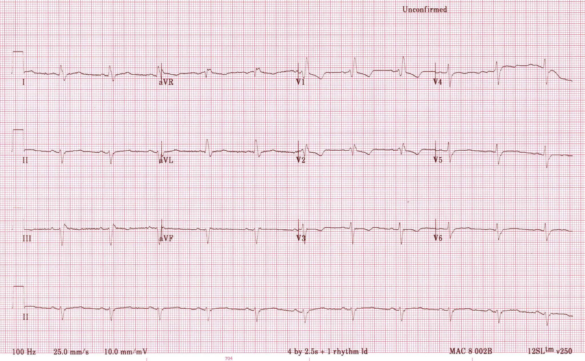 Anterior Myocardial Infarction Litfl Ecg Library 33024 Hot Sex Picture 