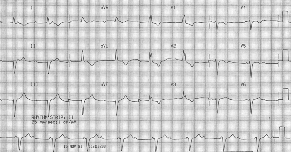 ECG90714 CHB RBBB Trifascicular