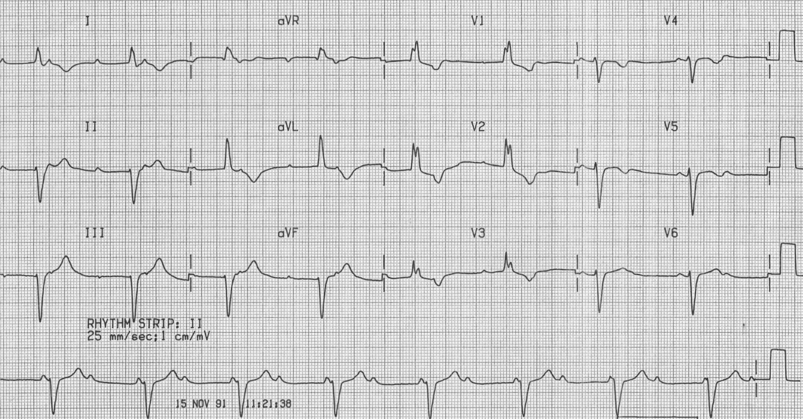 File:RBBB with first degree AV block.jpg - Wikipedia