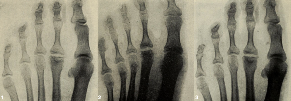Freiberg 1914 3 cases