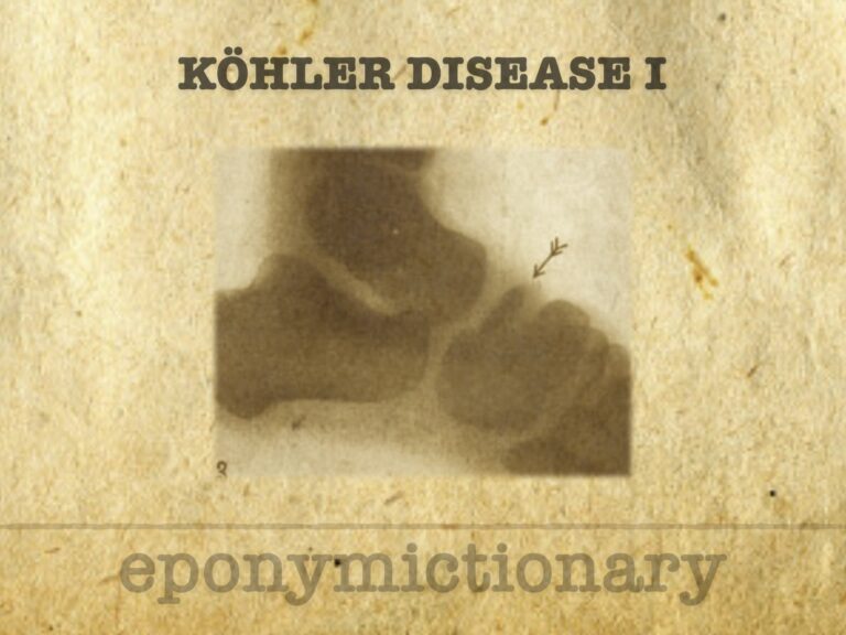 Köhler disease I 680