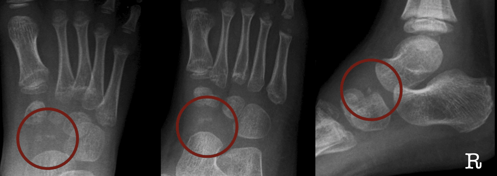 Kohler disease navicular labelled