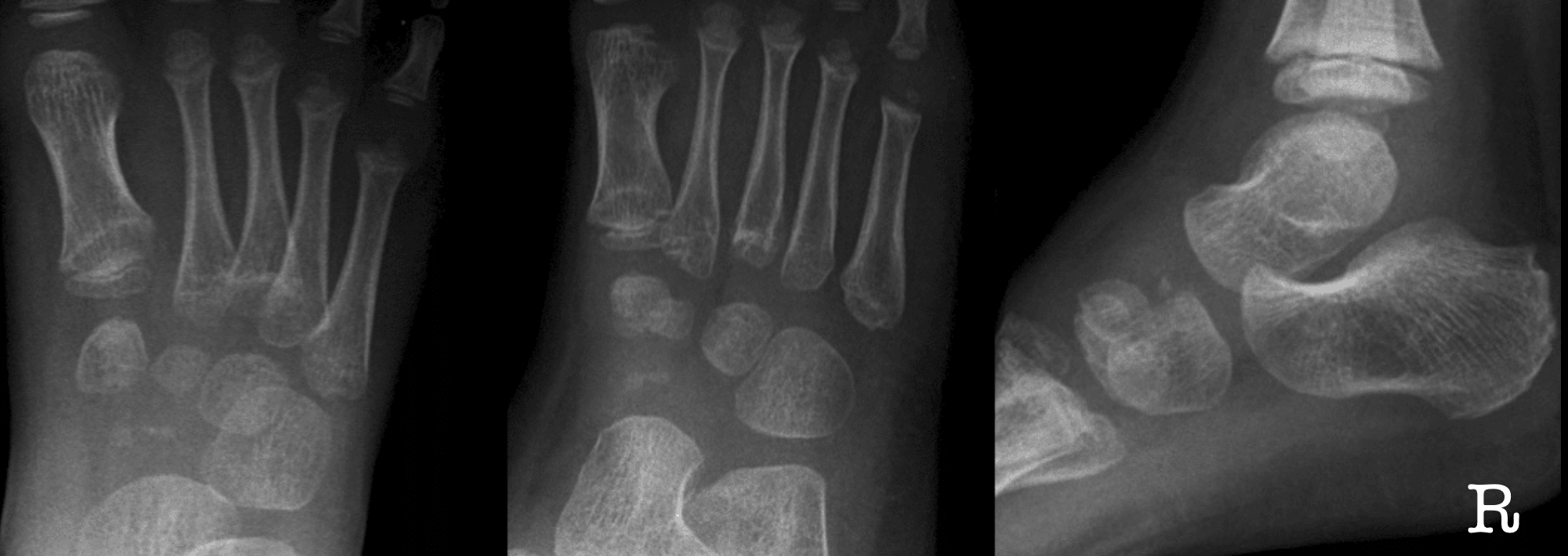 Kohler disease navicular