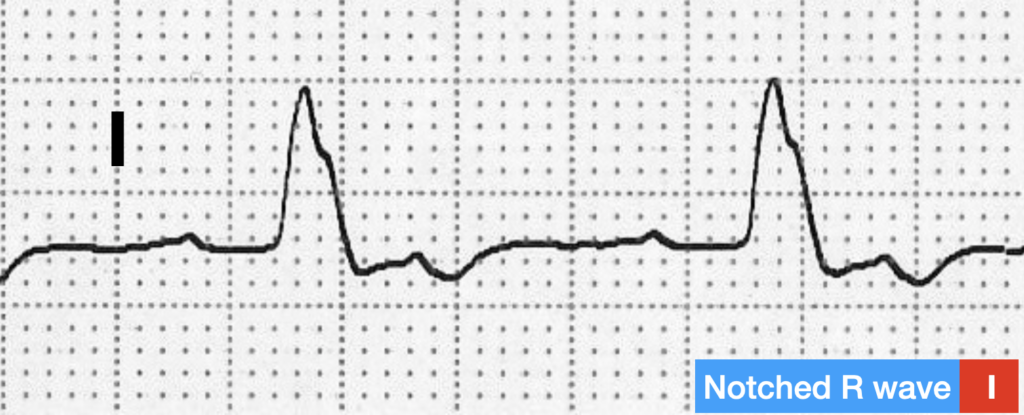 LBBB QRS morphology notched R wave