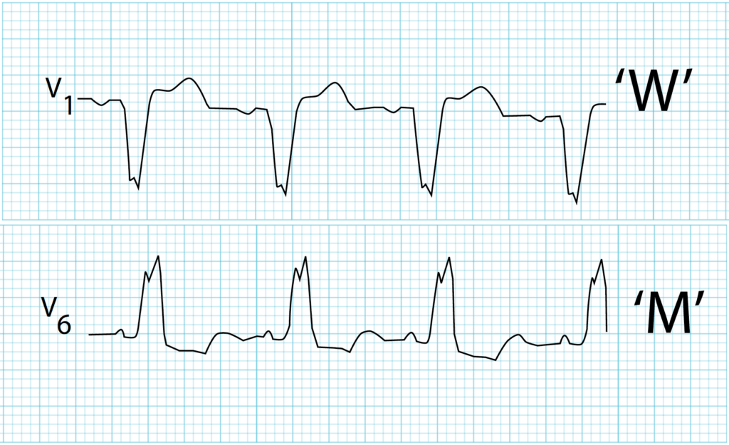 Left-Bundle-Branch-Block-LBBB ECG-Strip LITFL