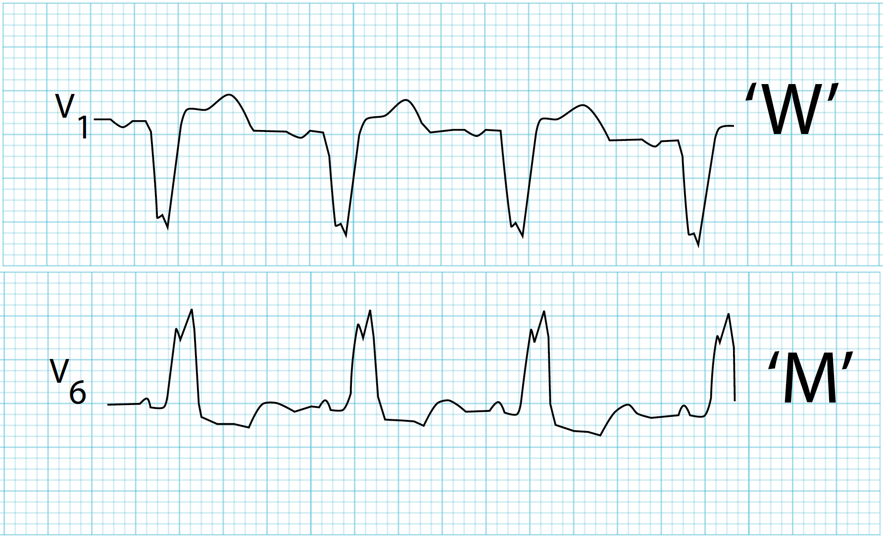 bundle branch block measurement