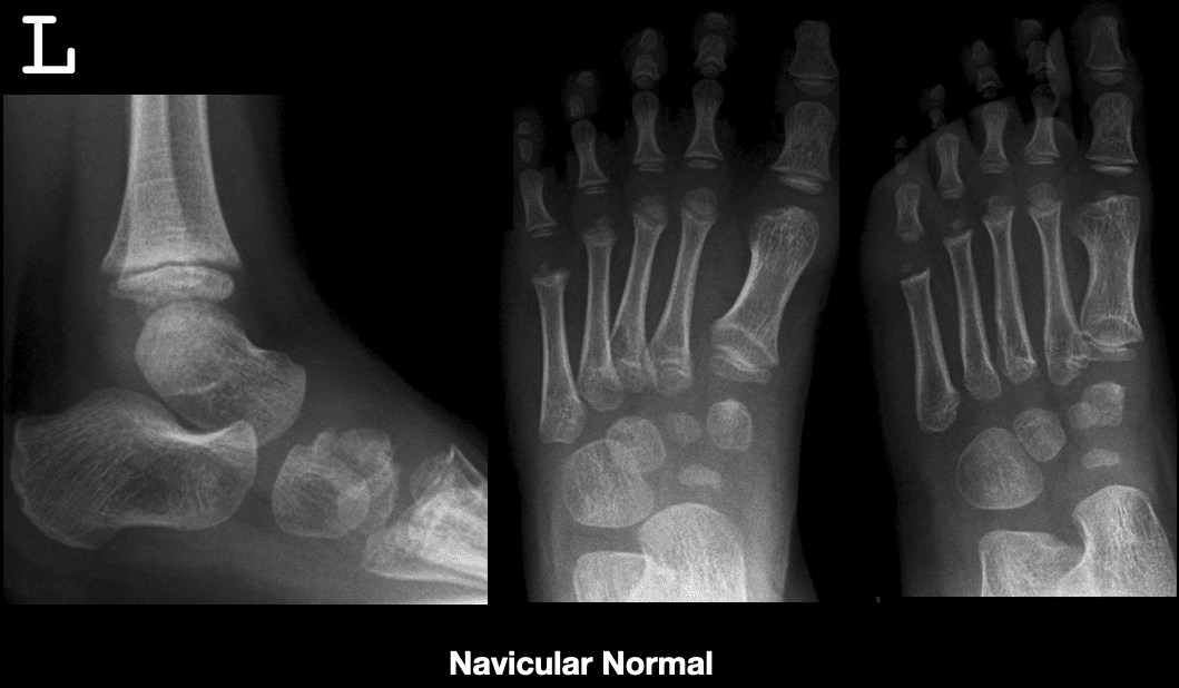 Left comparison - normal navicular 1