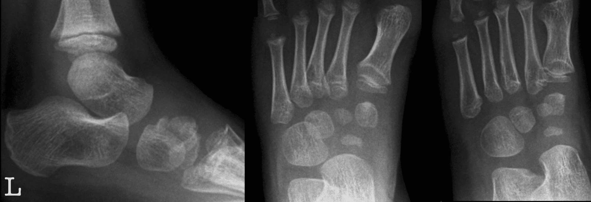 Navicular normal Kohler