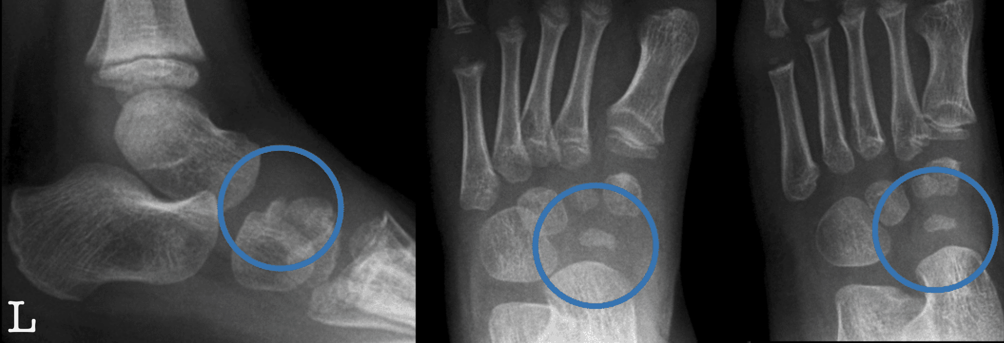 Navicular normal Kohler labelled