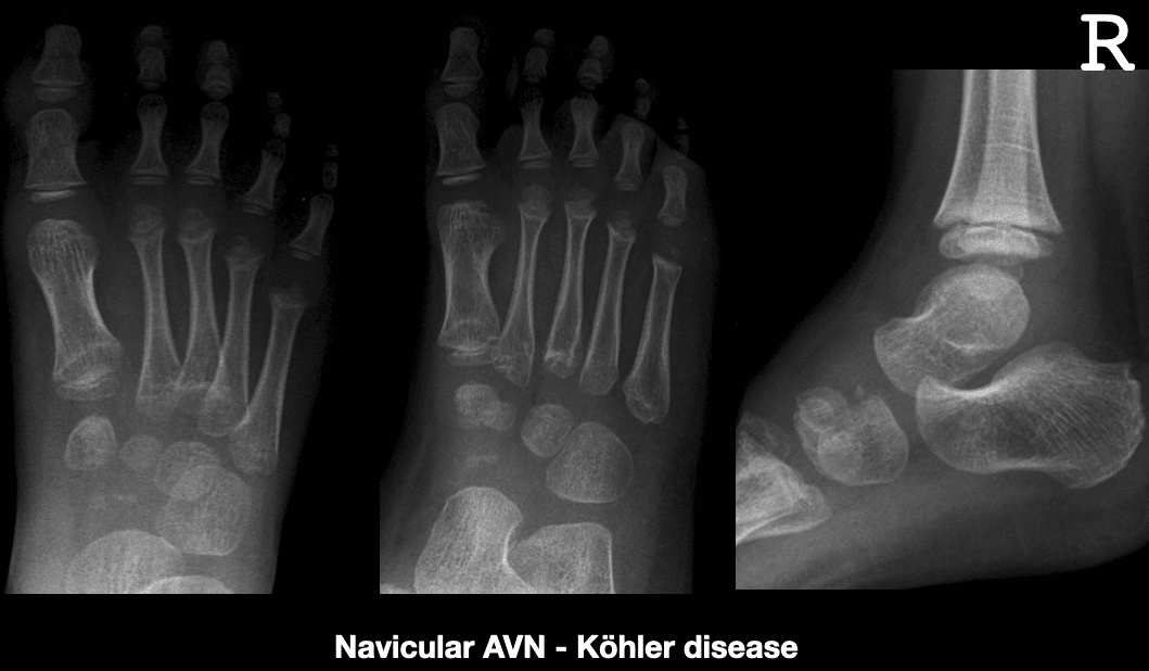 Right navicular avascular necrosis 2