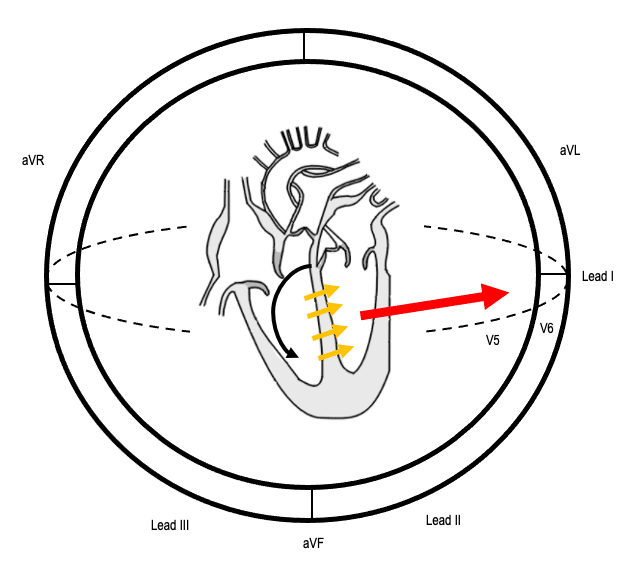 Sequence of conduction in LBBB