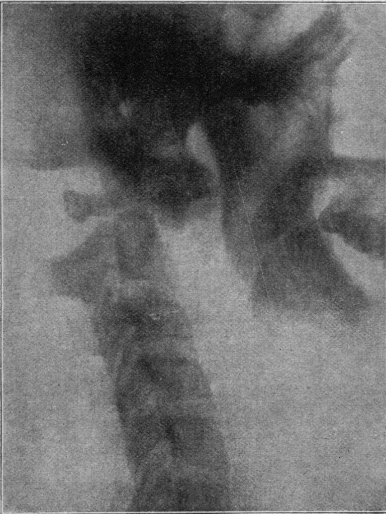 Swanberg 1919 nontraumatic atlas dislocation post tonsillectomy