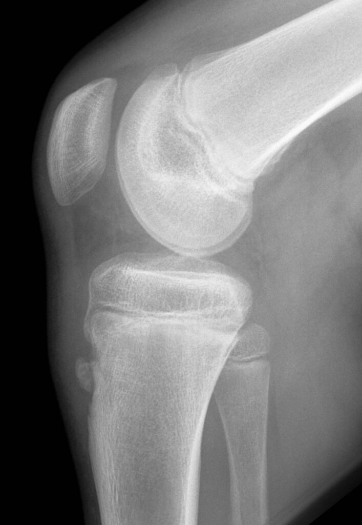 osgood-schlatter-disease