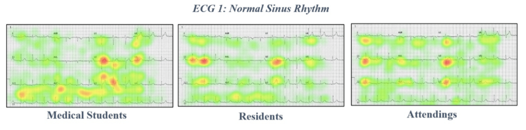 ECG 1 Normal sinus rhythm eye tracking data