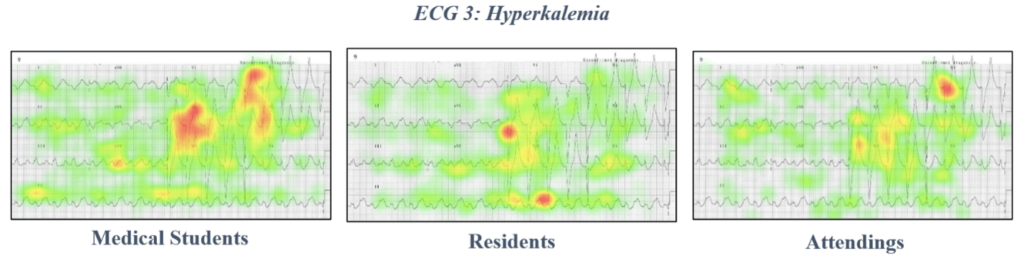 ECG 3 hyperkalemia eye tracking data