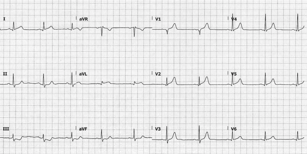 ECG SA flag OMI STEMI