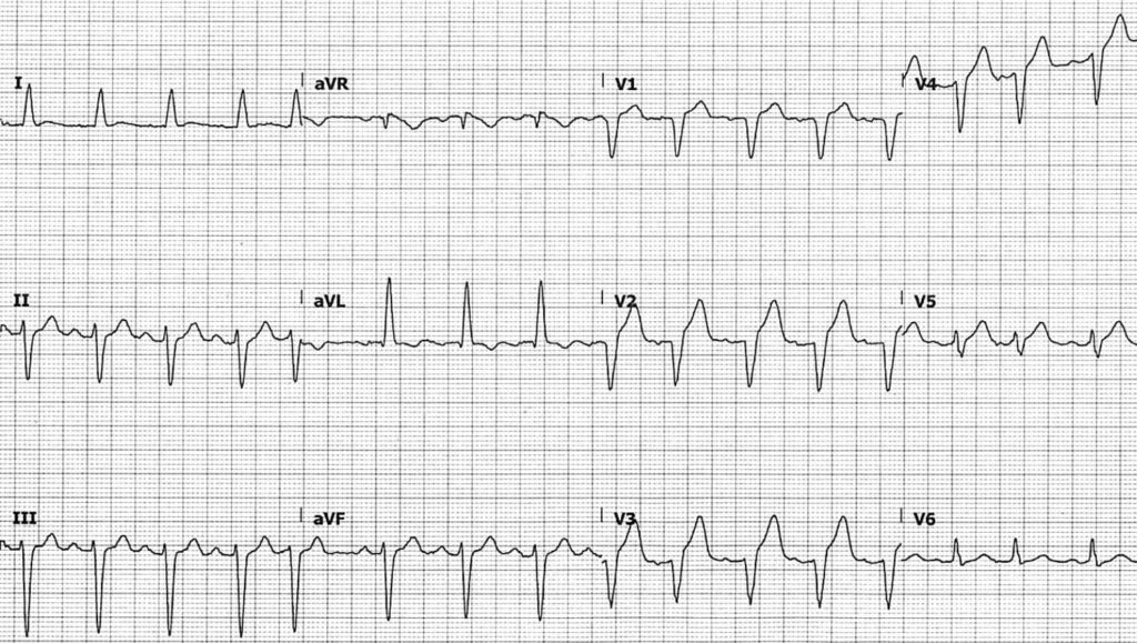 ECG Case 122 • LITFL • ECG Top 100 Self-Assessment Quiz