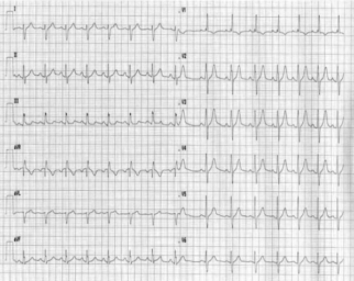 Crochetage sign • LITFL • ECG Library Diagnosis