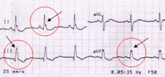 Crochetage sign • LITFL • ECG Library Diagnosis