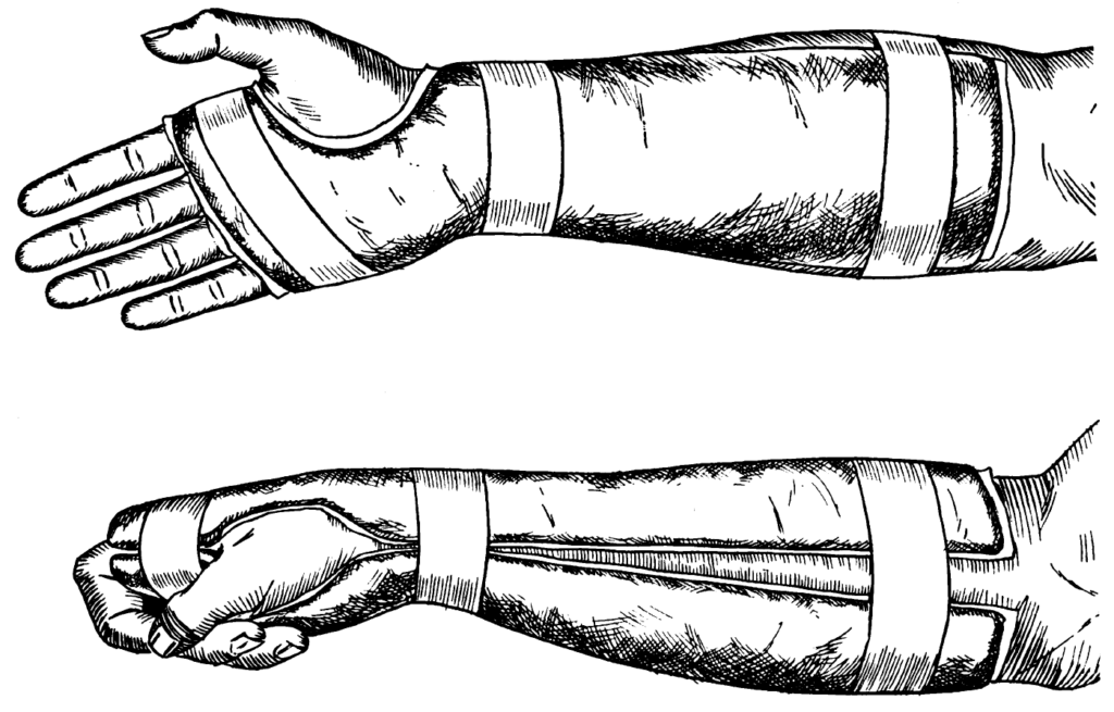 The molded plaster splint for Colles fractures with moderate Cotton-Loder position