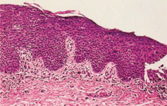 Bowenoid papulosis 1977 Kopf Bart