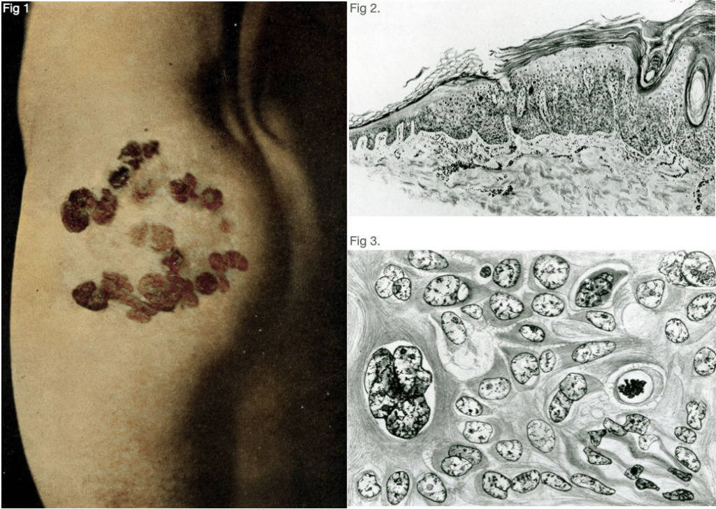 Bowen's disease Precancerous Dermatosis of Bowen 1912 Case 1