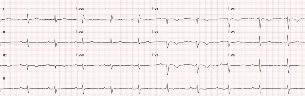 ECG Case 123 LITFL