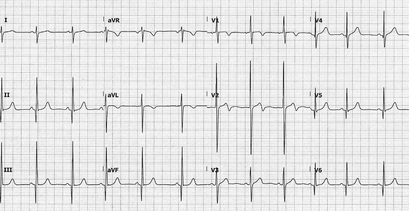 Hypertrophic Cardiomyopathy (HCM) • LITFL • ECG Library Diagnosis