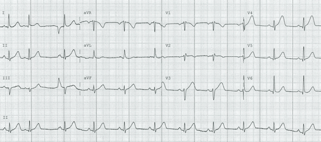 ECG-Case-125-1