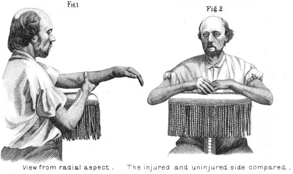 Moore fracture. 1870