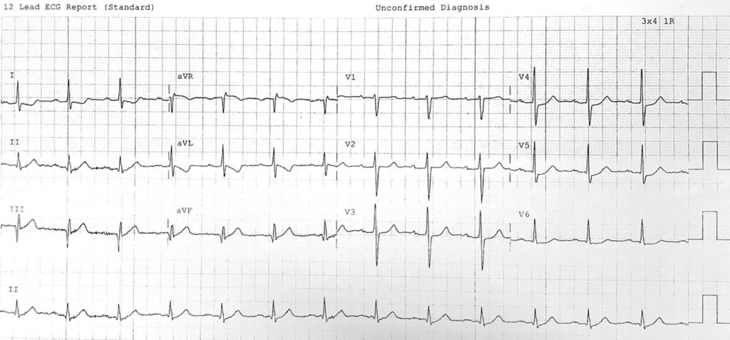 Inferior OMI ECG LITFL