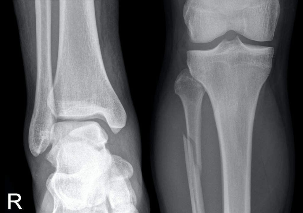 Maisonneuve fracture LITFL 2021