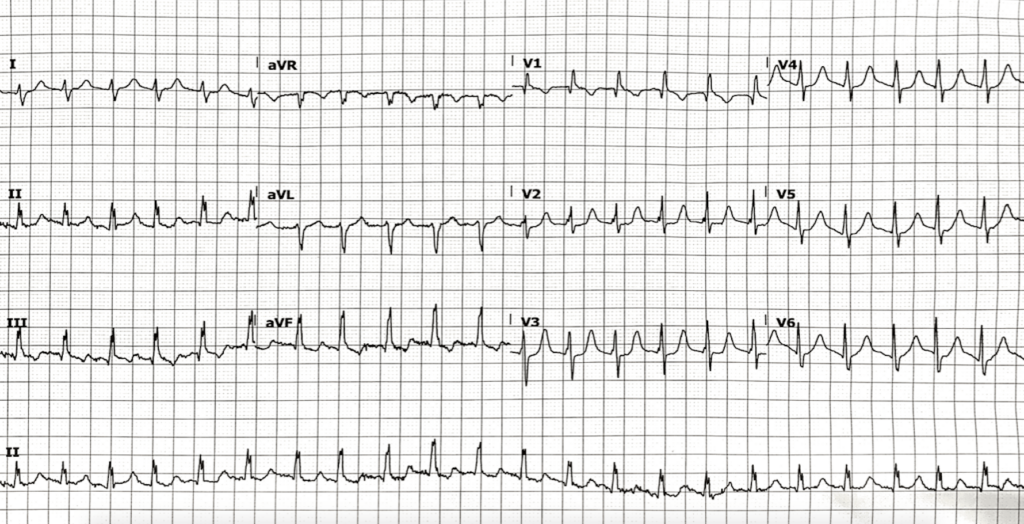 ECG Case 130