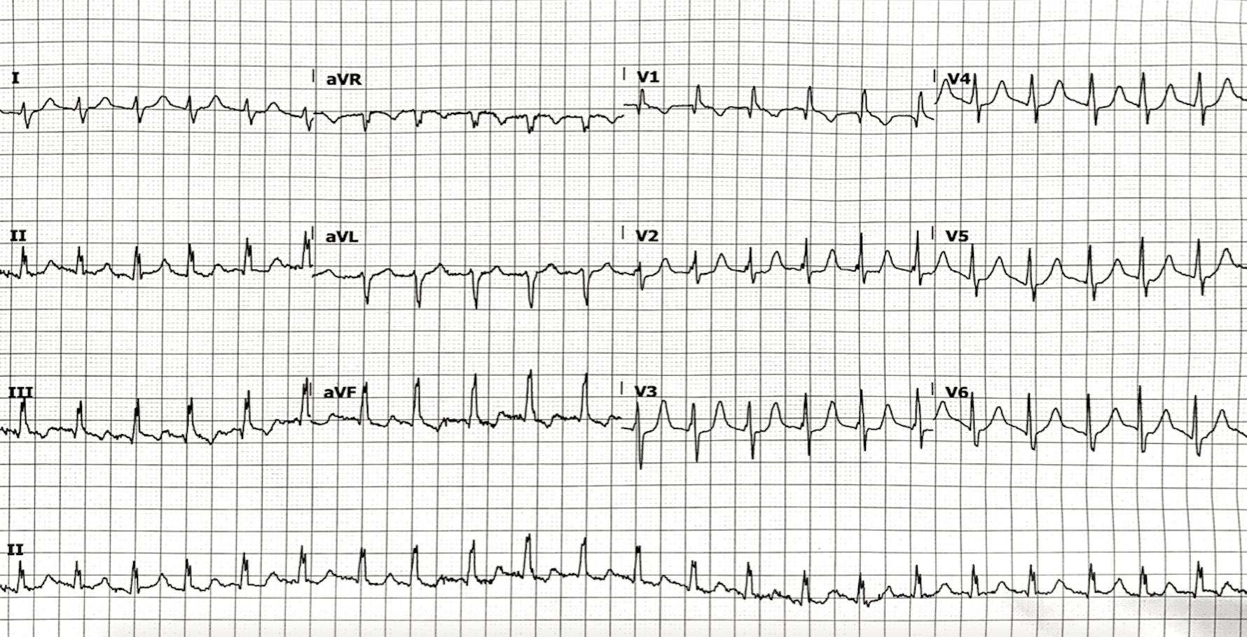 Crochetage sign • LITFL • ECG Library Diagnosis