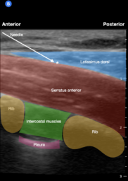 Serratus Anterior Plane Block • LITFL • Nerve Block Library