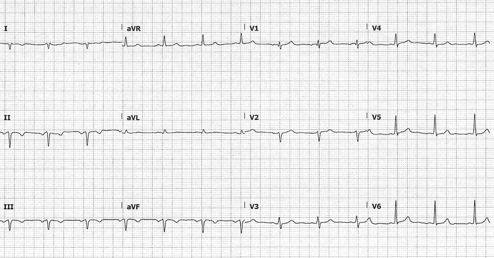 ECG Rate Interpretation • LITFL Medical Blog • ECG Library Basics